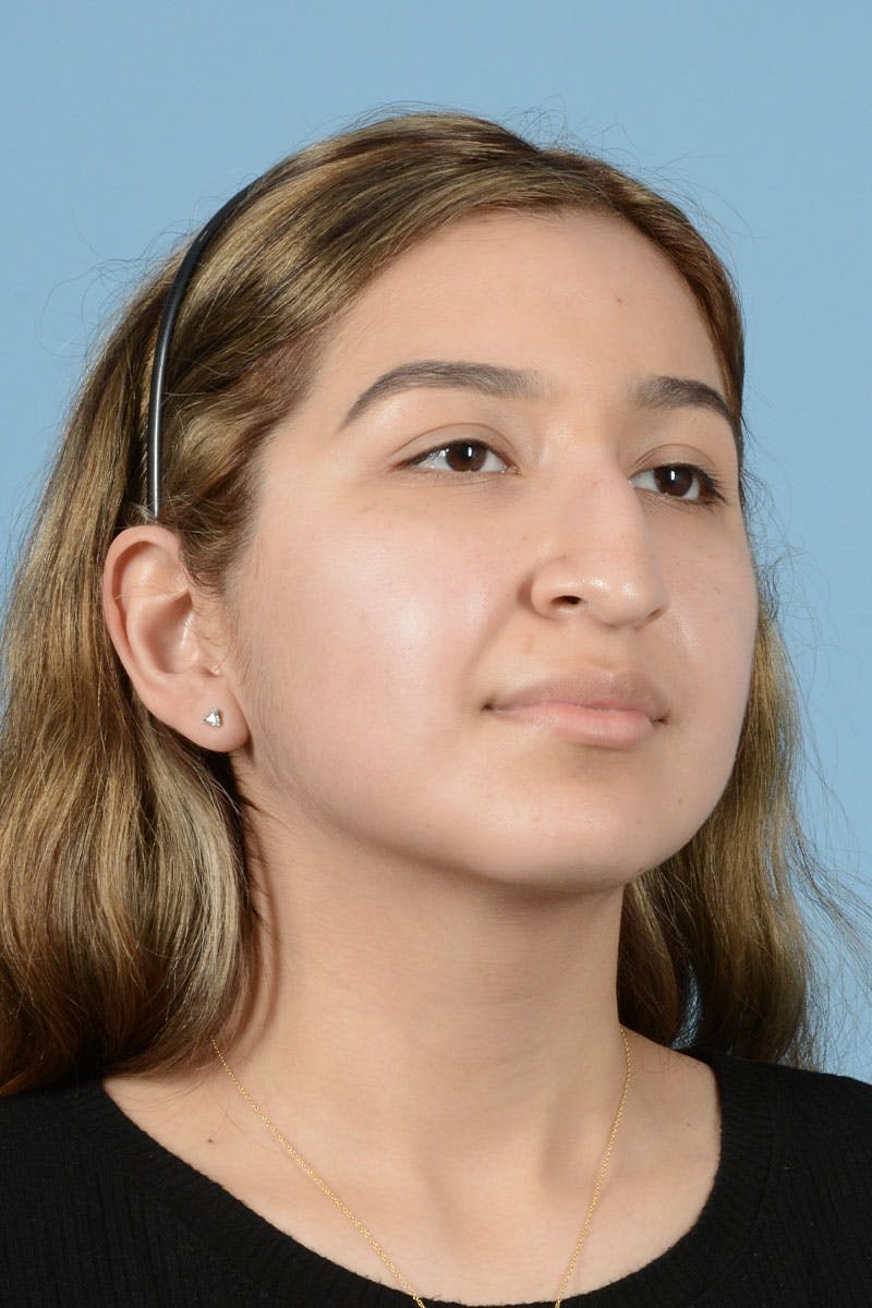 Rhinoplasty Before & After Gallery - Patient 336440 - Image 9