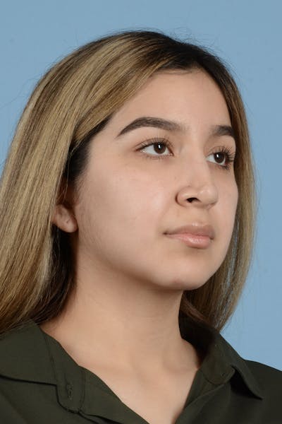Rhinoplasty Before & After Gallery - Patient 336440 - Image 10
