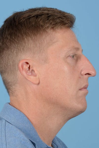 Rhinoplasty Before & After Gallery - Patient 406935 - Image 1
