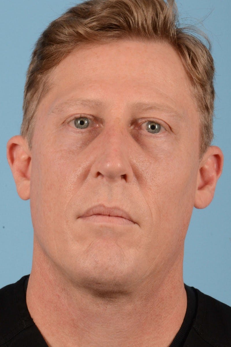 Rhinoplasty Before & After Gallery - Patient 406935 - Image 4