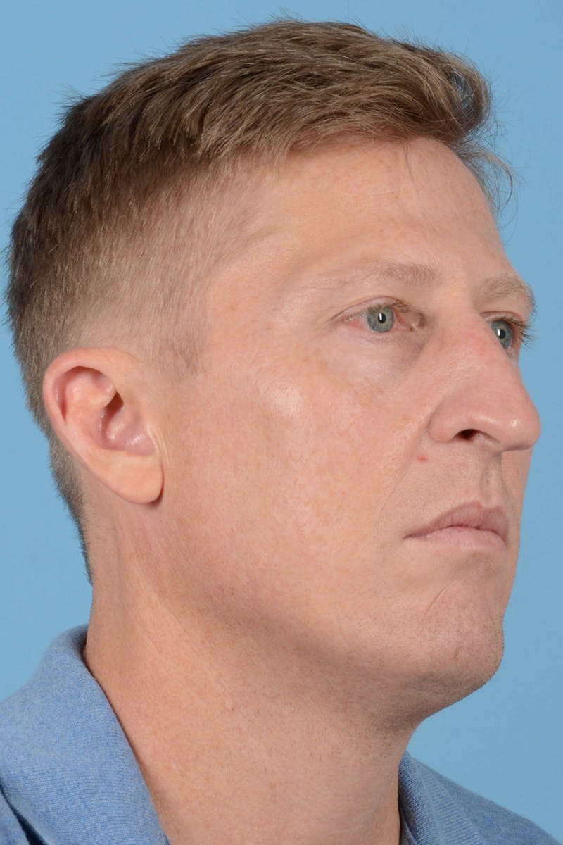 Rhinoplasty Before & After Gallery - Patient 406935 - Image 5