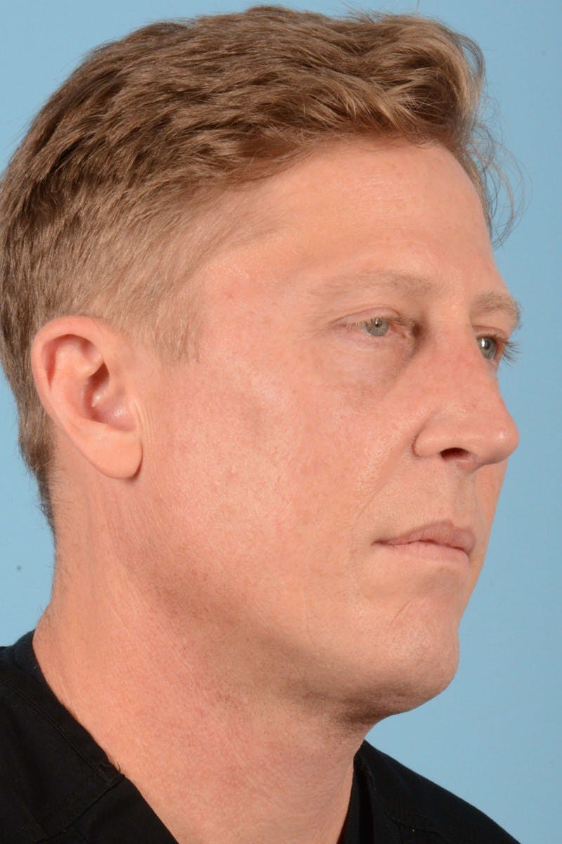 Rhinoplasty Before & After Gallery - Patient 406935 - Image 6