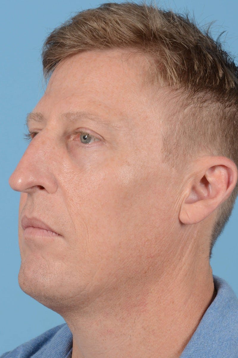 Rhinoplasty Before & After Gallery - Patient 406935 - Image 7