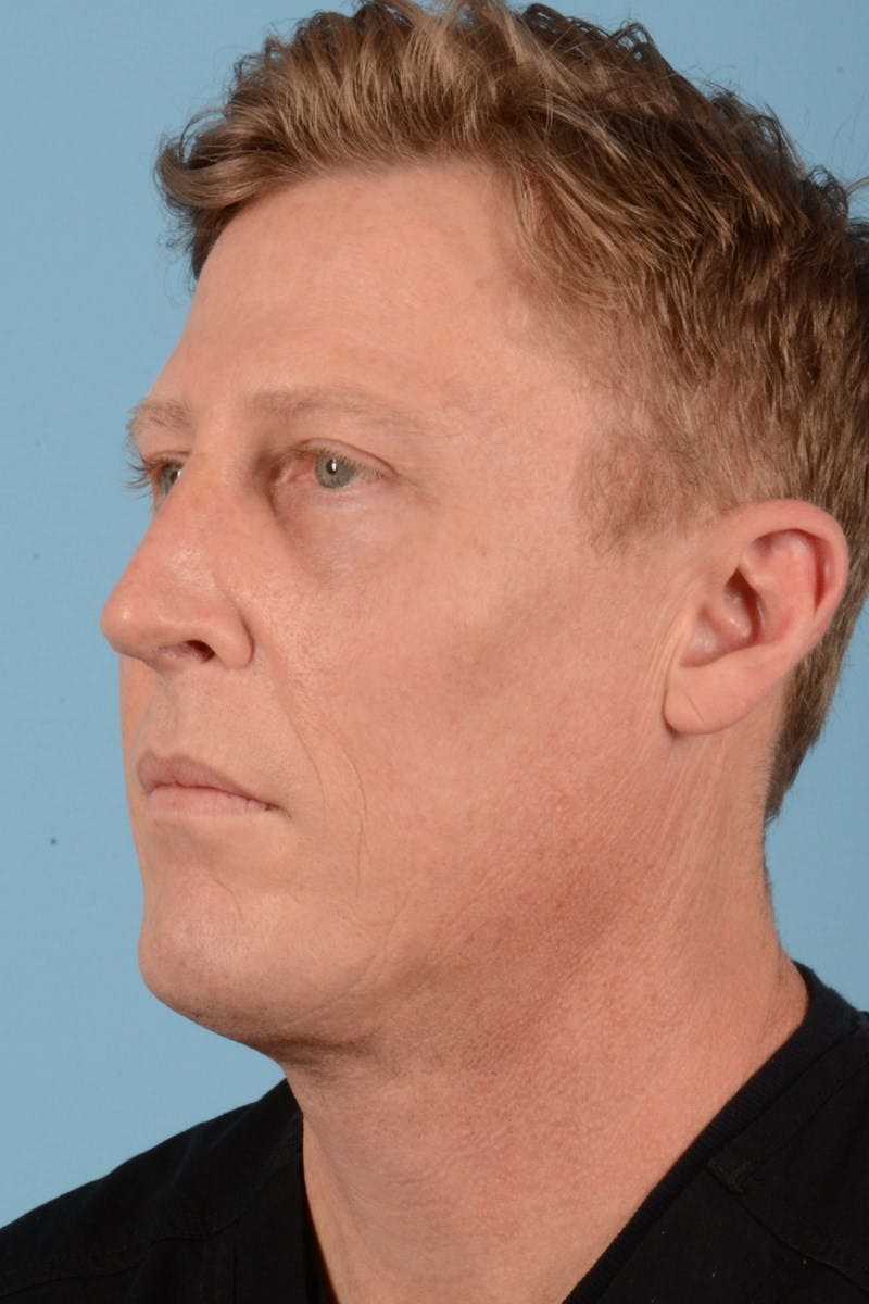 Rhinoplasty Before & After Gallery - Patient 406935 - Image 8