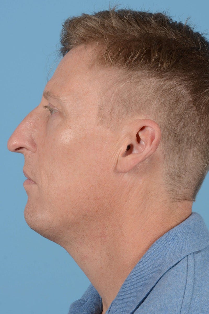 Rhinoplasty Before & After Gallery - Patient 406935 - Image 9