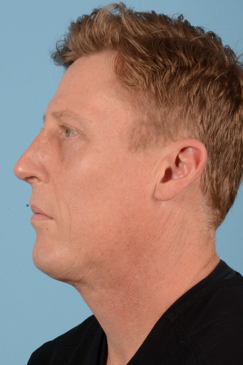Rhinoplasty Before & After Gallery - Patient 406935 - Image 10