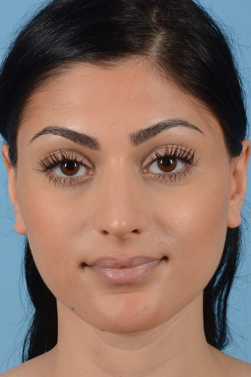 Rhinoplasty Before & After Gallery - Patient 545688 - Image 3