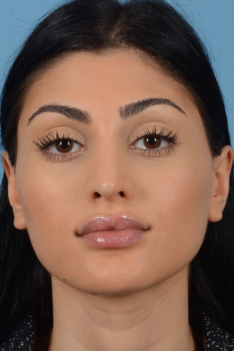 Rhinoplasty Before & After Gallery - Patient 545688 - Image 4