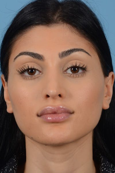 Rhinoplasty Before & After Gallery - Patient 545688 - Image 4
