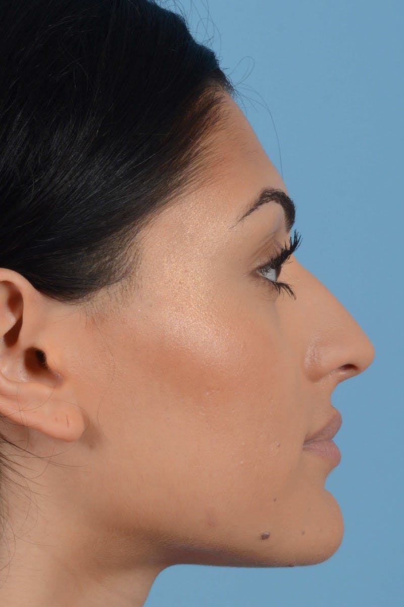Rhinoplasty Before & After Gallery - Patient 545688 - Image 5