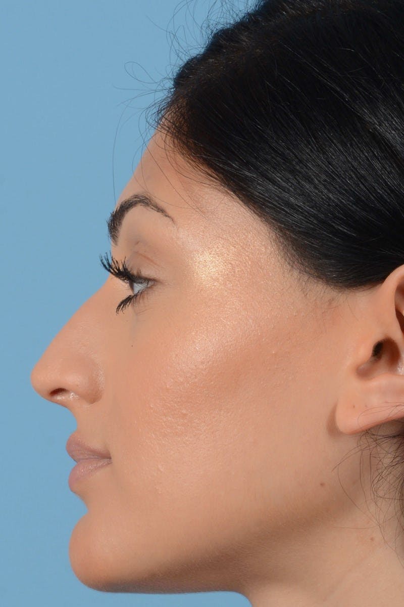Rhinoplasty Before & After Gallery - Patient 545688 - Image 7