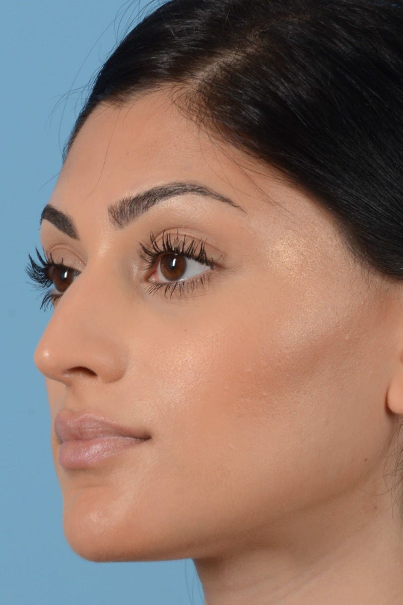 Rhinoplasty Before & After Gallery - Patient 545688 - Image 9
