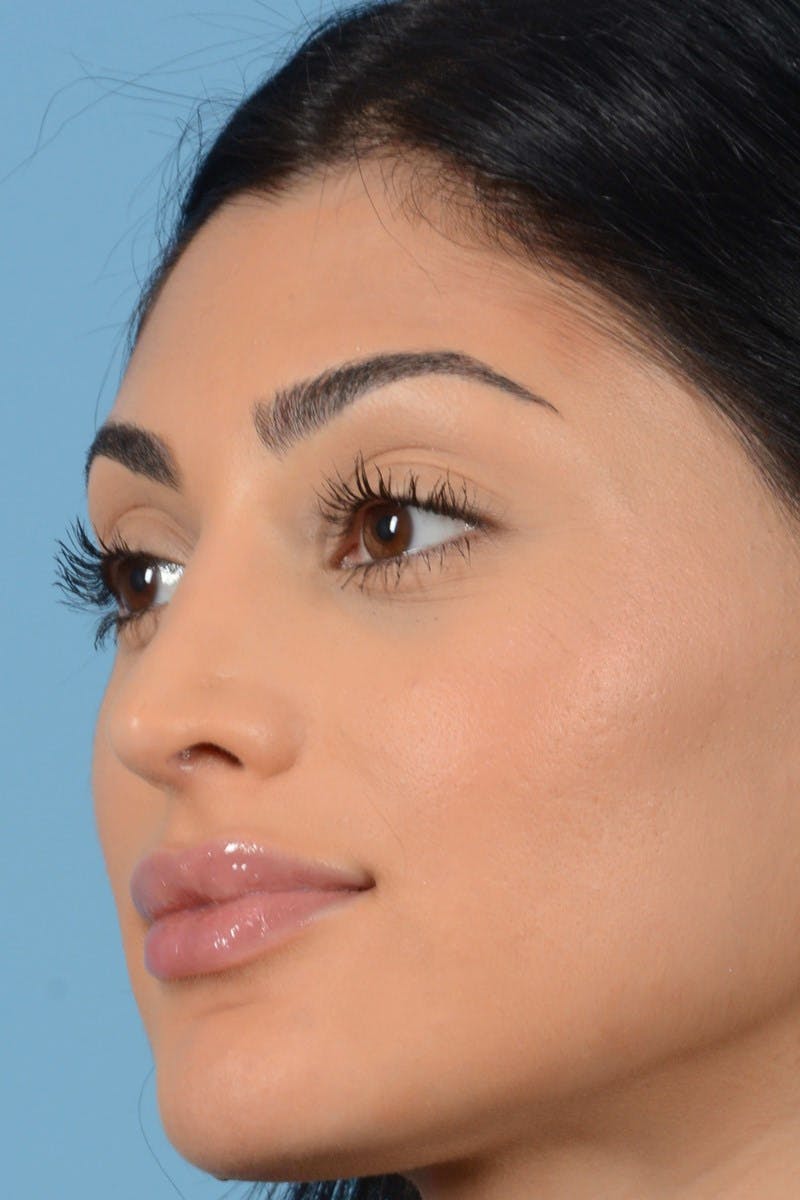 Rhinoplasty Before & After Gallery - Patient 545688 - Image 10