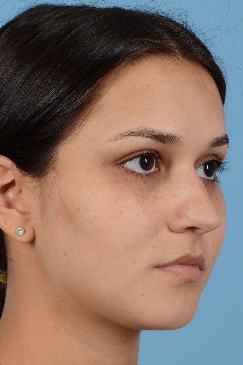 Rhinoplasty Before & After Gallery - Patient 296459 - Image 3