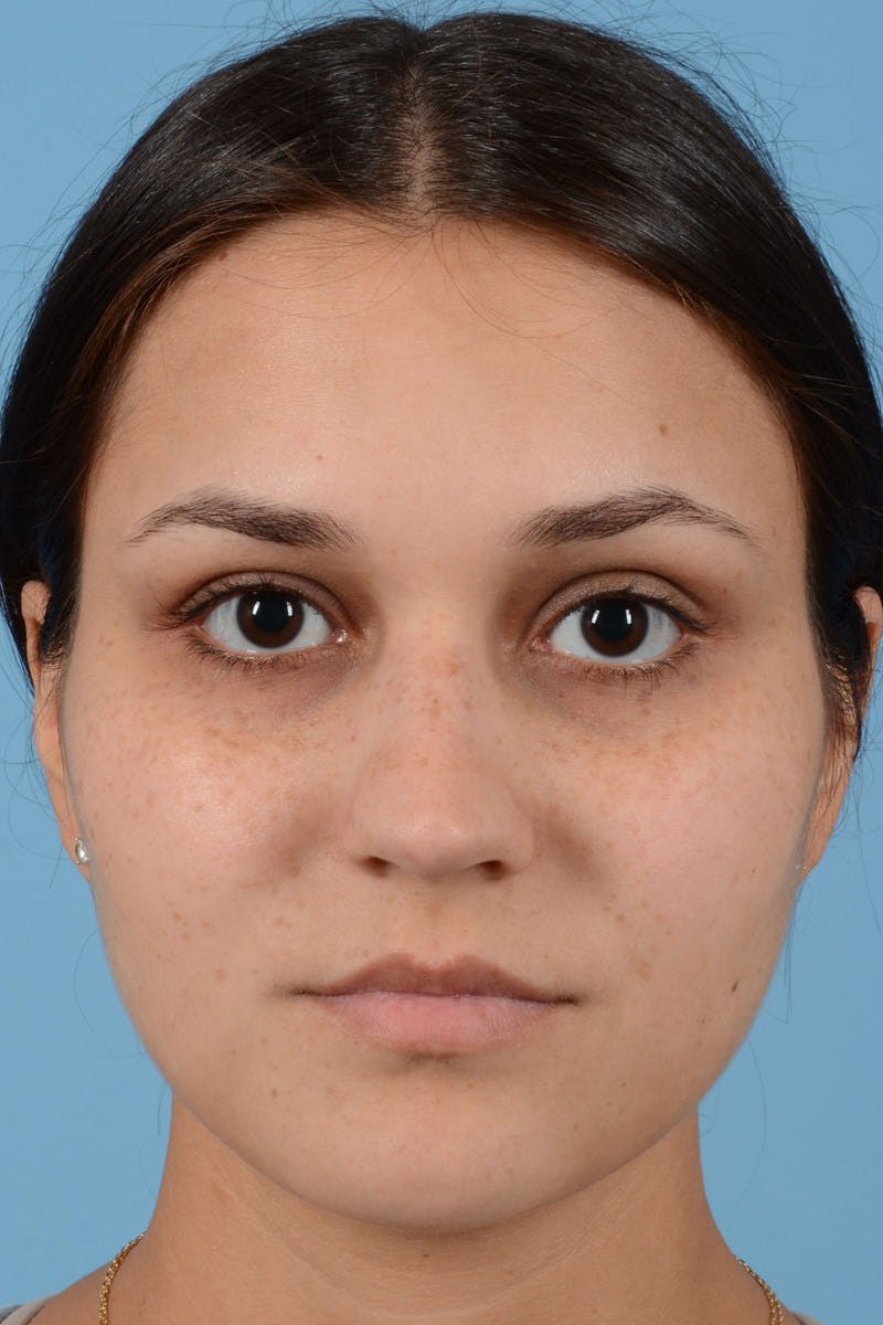 Rhinoplasty Before & After Gallery - Patient 296459 - Image 5