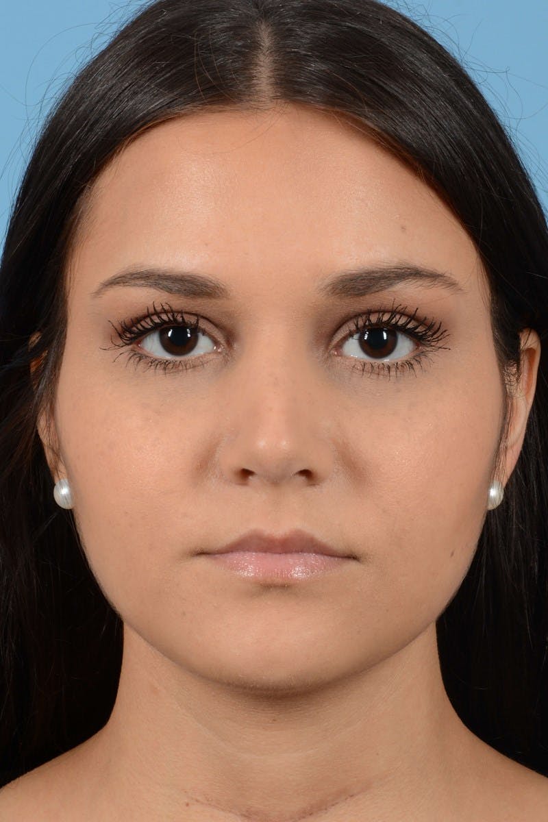Rhinoplasty Before & After Gallery - Patient 296459 - Image 6