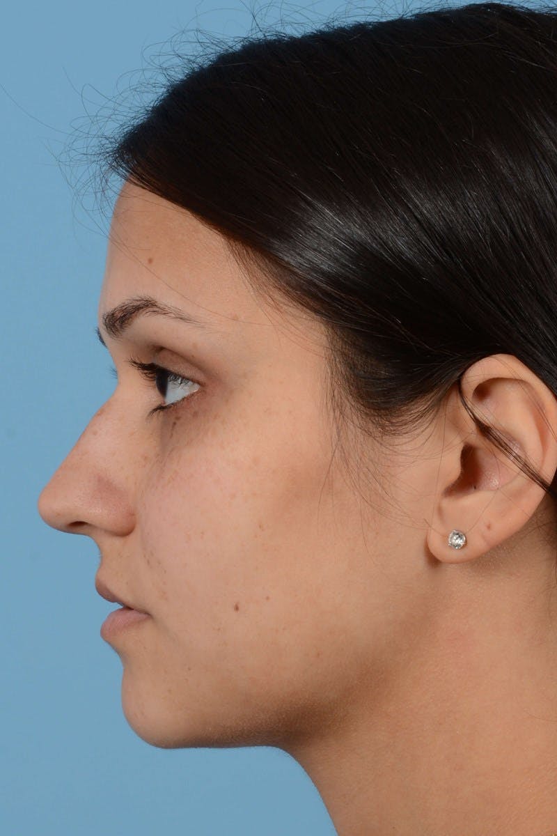 Rhinoplasty Before & After Gallery - Patient 296459 - Image 7