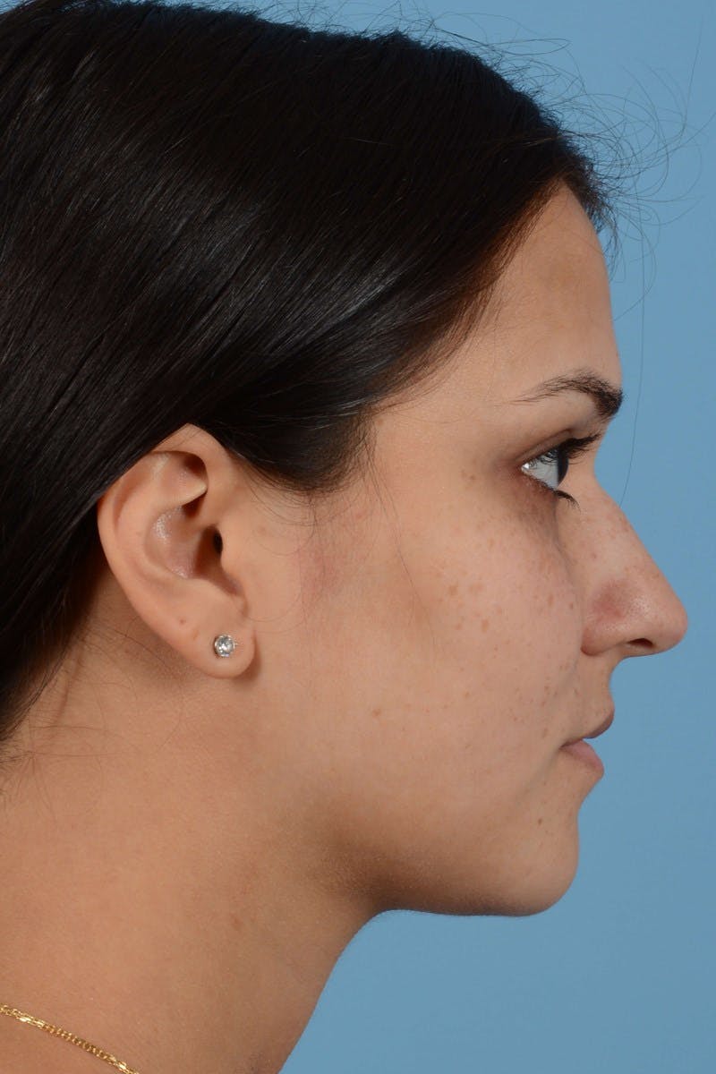 Rhinoplasty Before & After Gallery - Patient 296459 - Image 9