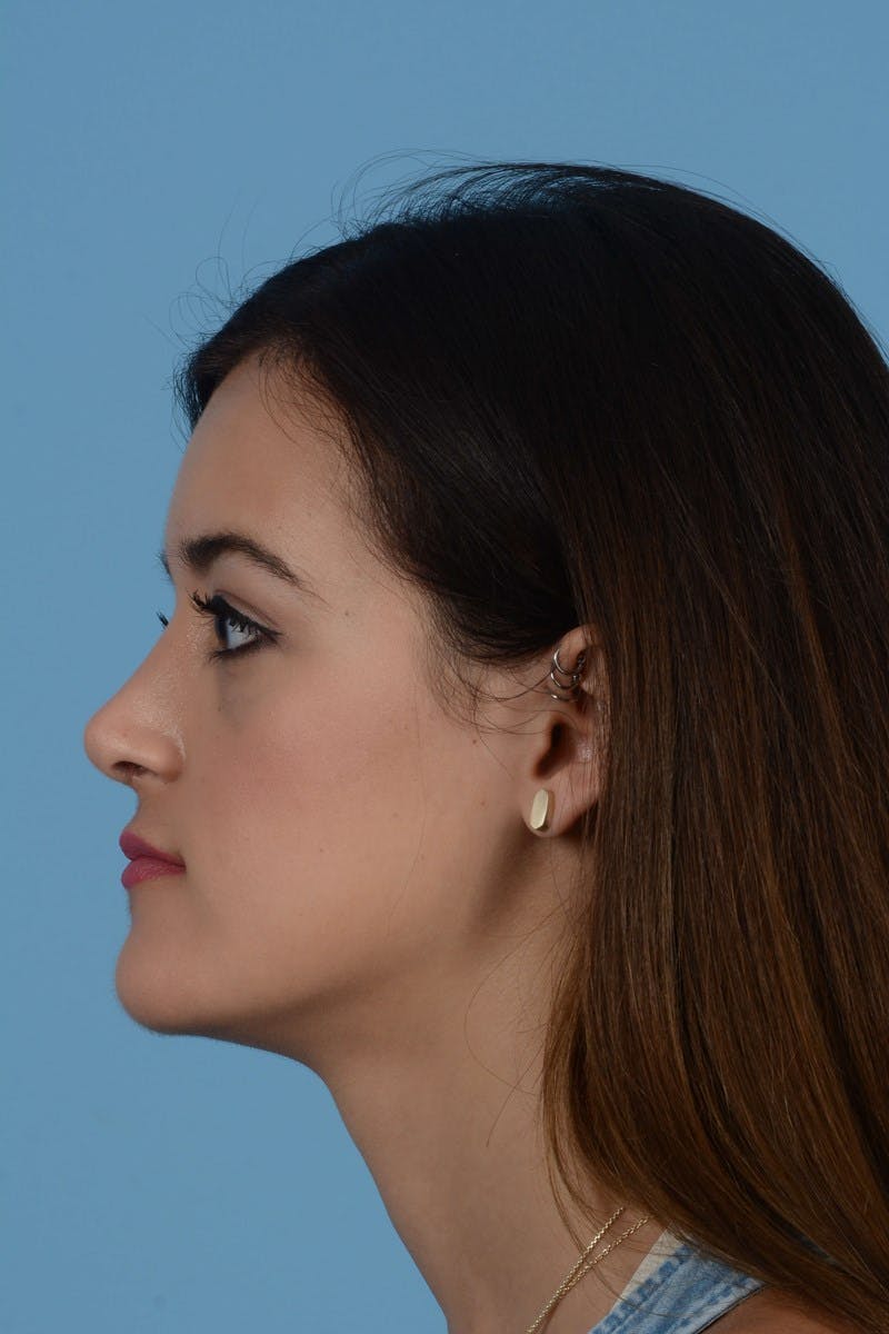 Rhinoplasty Before & After Gallery - Patient 234239 - Image 2