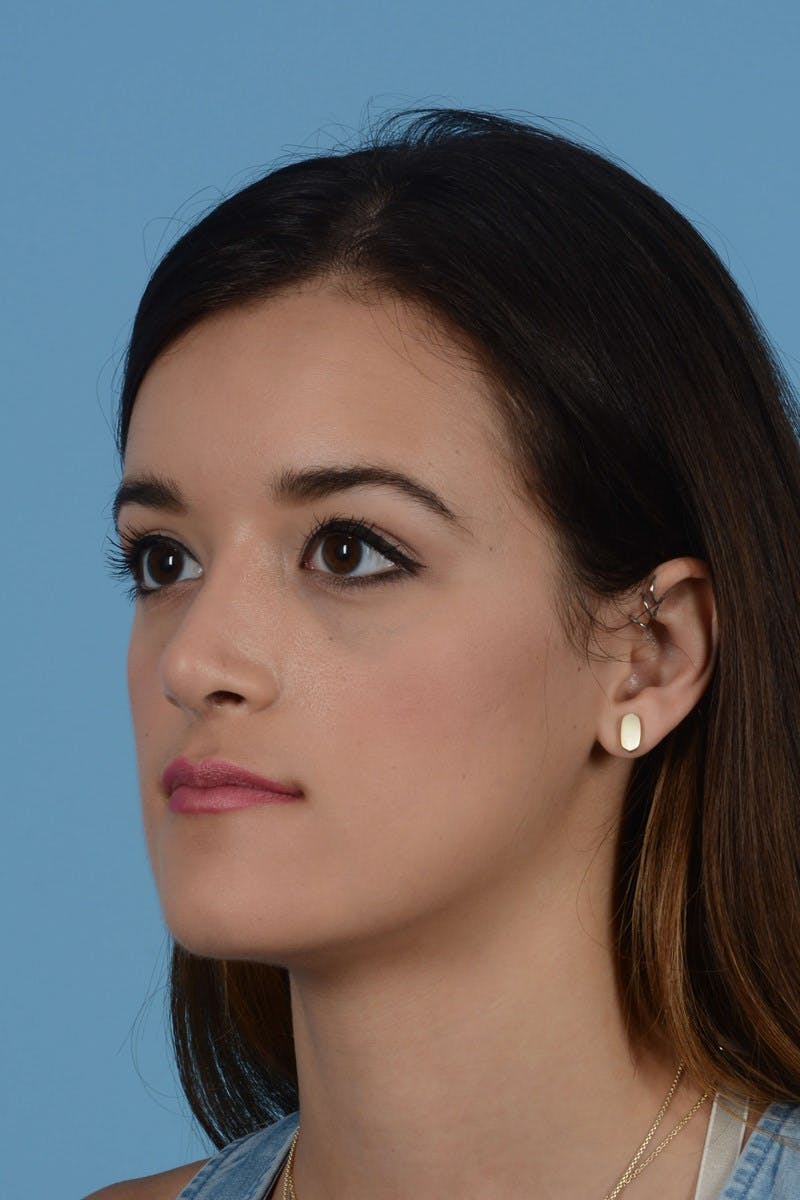Rhinoplasty Before & After Gallery - Patient 234239 - Image 4