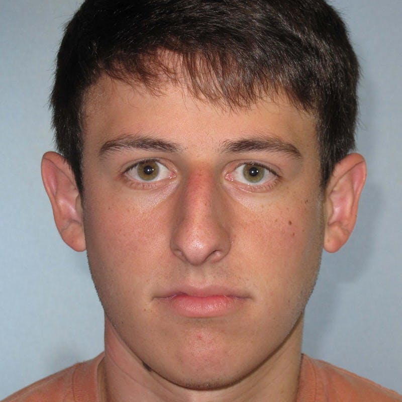 Rhinoplasty Before & After Gallery - Patient 192739 - Image 3