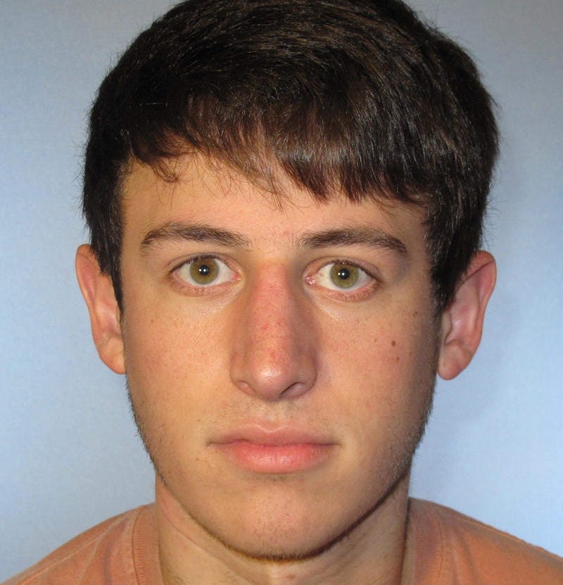 Rhinoplasty Before & After Gallery - Patient 192739 - Image 4