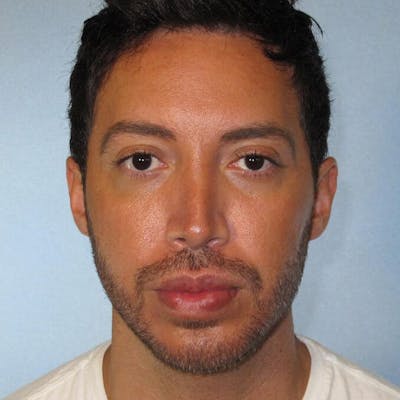 Rhinoplasty Before & After Gallery - Patient 592112 - Image 4