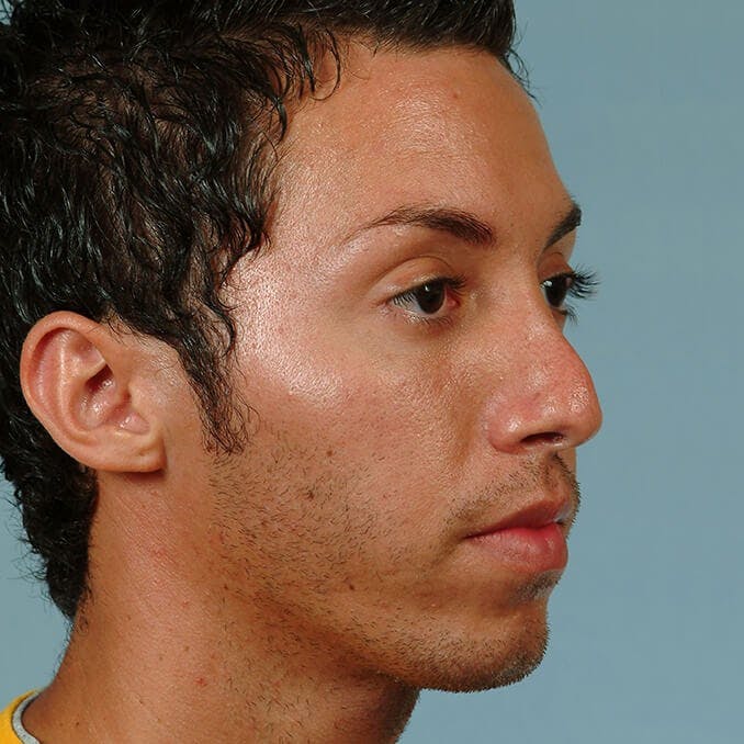 Rhinoplasty Before & After Gallery - Patient 592112 - Image 5