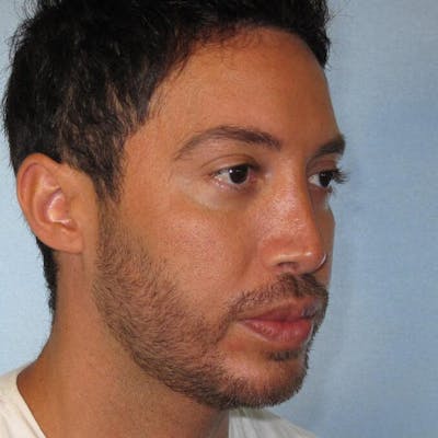 Rhinoplasty Before & After Gallery - Patient 592112 - Image 6