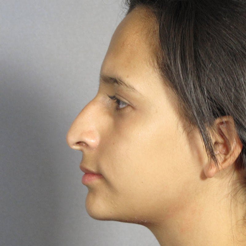 Rhinoplasty Before & After Gallery - Patient 197485 - Image 1