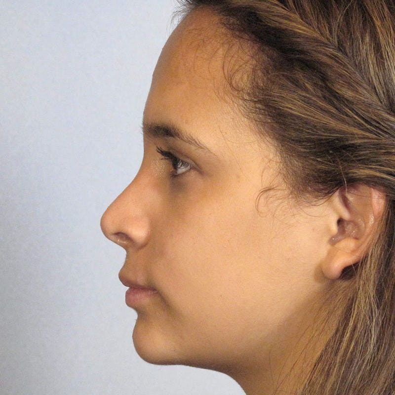 Rhinoplasty Before & After Gallery - Patient 197485 - Image 2