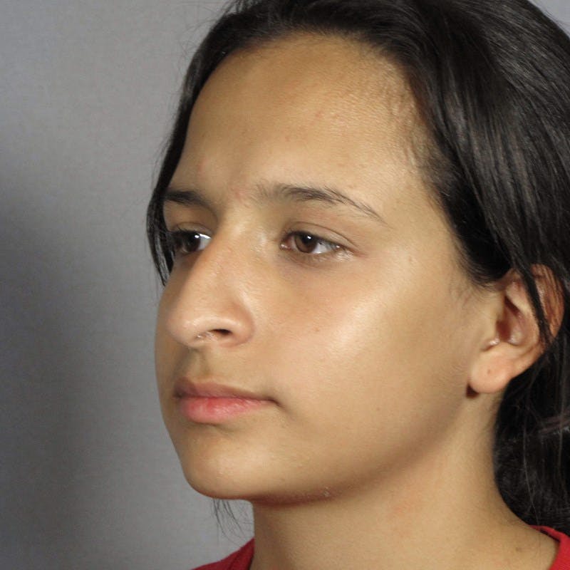 Rhinoplasty Before & After Gallery - Patient 197485 - Image 3