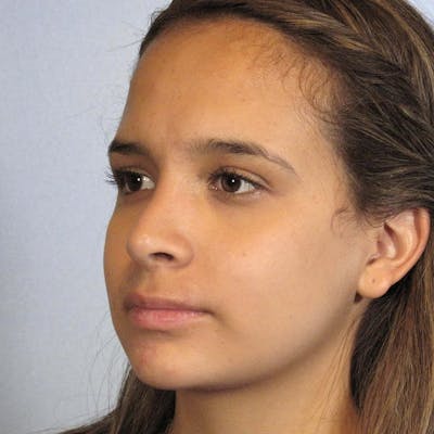 Rhinoplasty Before & After Gallery - Patient 197485 - Image 4