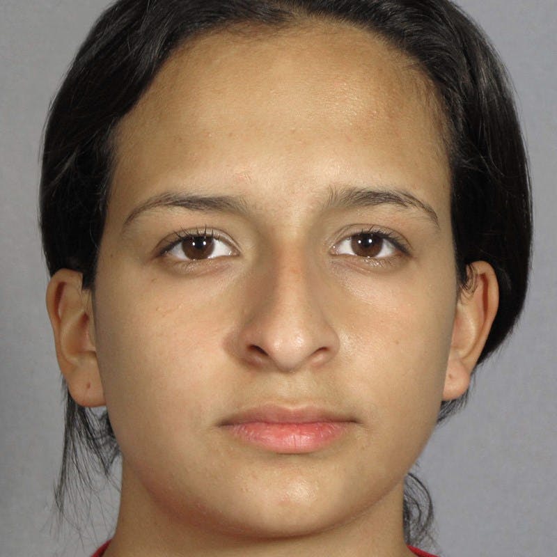 Rhinoplasty Before & After Gallery - Patient 197485 - Image 5
