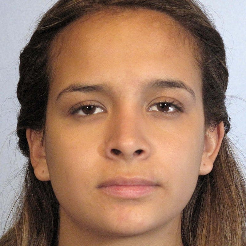Rhinoplasty Before & After Gallery - Patient 197485 - Image 6