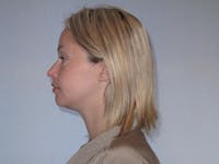 Rhinoplasty Before & After Gallery - Patient 458308 - Image 1