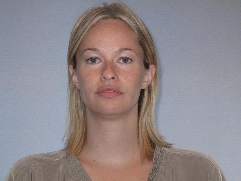 Rhinoplasty Before & After Gallery - Patient 458308 - Image 3
