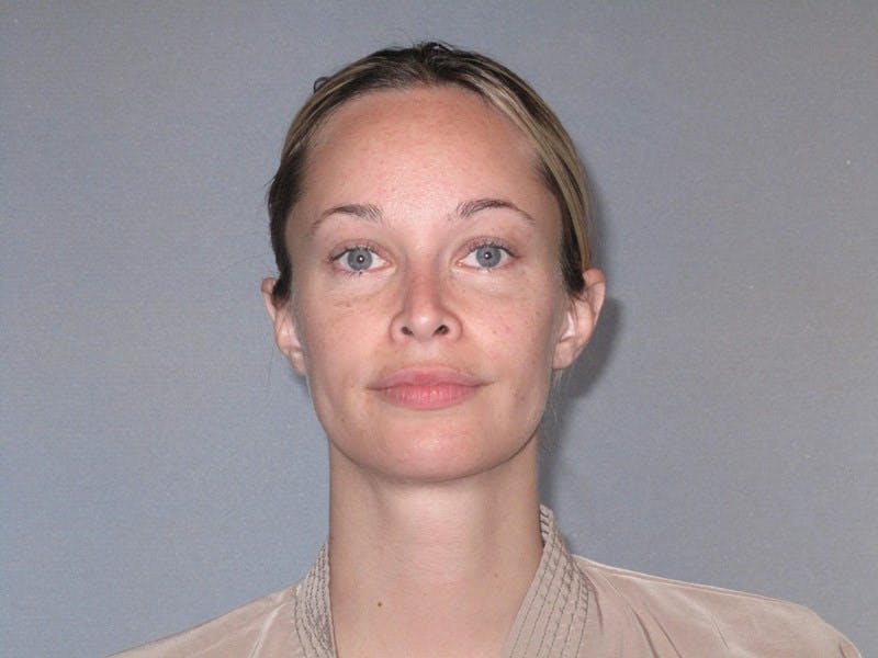 Rhinoplasty Before & After Gallery - Patient 458308 - Image 4