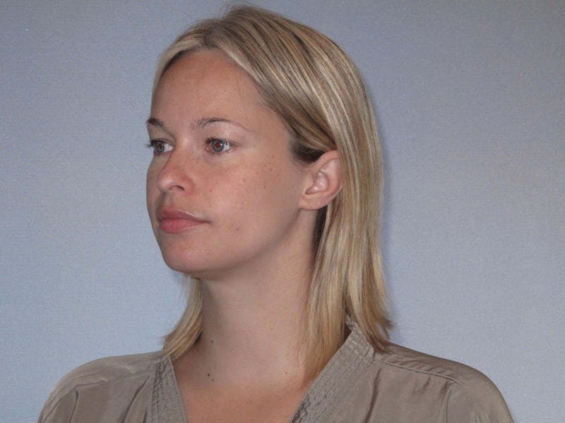 Rhinoplasty Before & After Gallery - Patient 458308 - Image 5