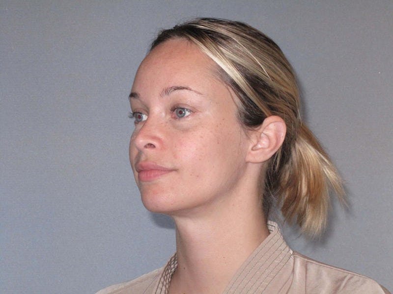 Rhinoplasty Before & After Gallery - Patient 458308 - Image 6