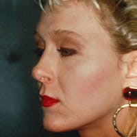 Rhinoplasty Before & After Gallery - Patient 330218 - Image 1