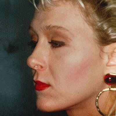 Rhinoplasty Before & After Gallery - Patient 330218 - Image 1