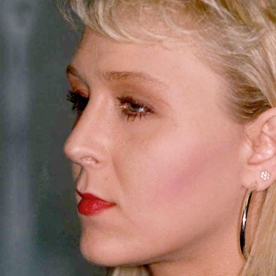 Rhinoplasty Before & After Gallery - Patient 330218 - Image 2