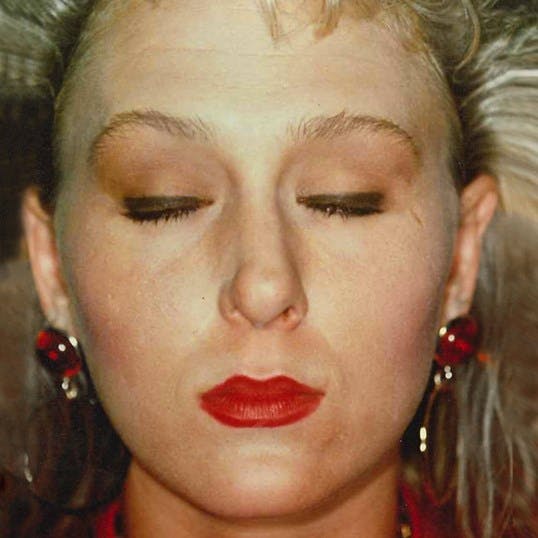 Rhinoplasty Before & After Gallery - Patient 330218 - Image 3