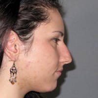 Rhinoplasty Before & After Gallery - Patient 305189 - Image 1