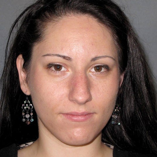 Rhinoplasty Before & After Gallery - Patient 305189 - Image 3