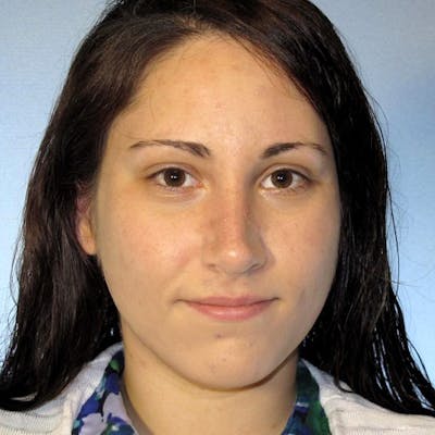 Rhinoplasty Before & After Gallery - Patient 305189 - Image 4