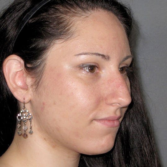 Rhinoplasty Before & After Gallery - Patient 305189 - Image 5