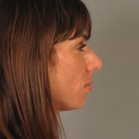 Rhinoplasty Before & After Gallery - Patient 251715 - Image 1