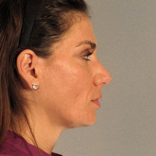 Rhinoplasty Before & After Gallery - Patient 251715 - Image 2